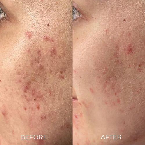 image acne, texture, pigmentation before after woman
