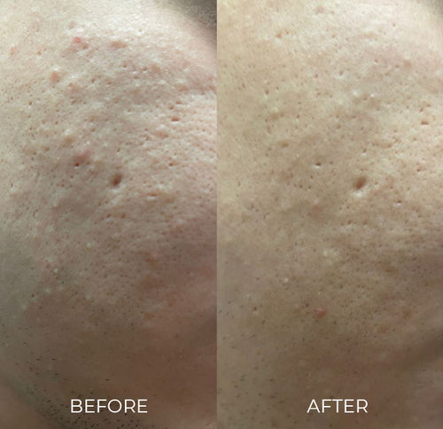 image acne, texture, pigmentation before after man