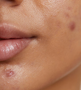 image close up of clogged pores and breakouts