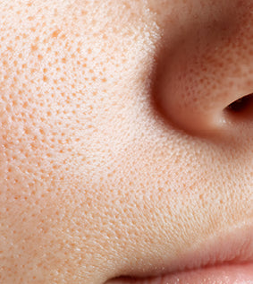image close up of enlarged pores