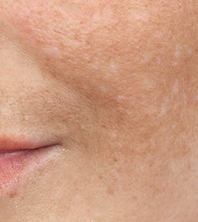 image close up of hyperpigmentation